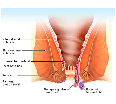 Illustration of how hemorrhoids affect for the awareness of patients by hemorrhoids surgery specialist in Hyderabad