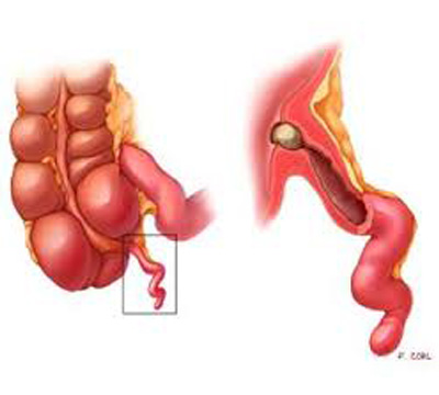 best appendicitis doctor in Hyderabad