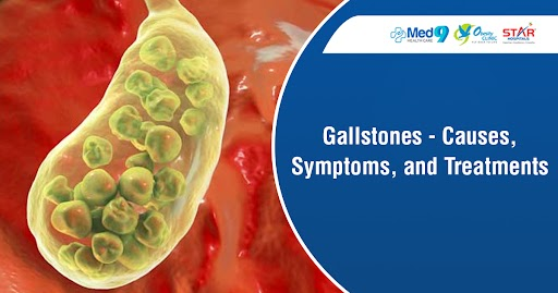 what-problems-do-gallstones-cause-gallstones-causes-symptoms-and-treatments